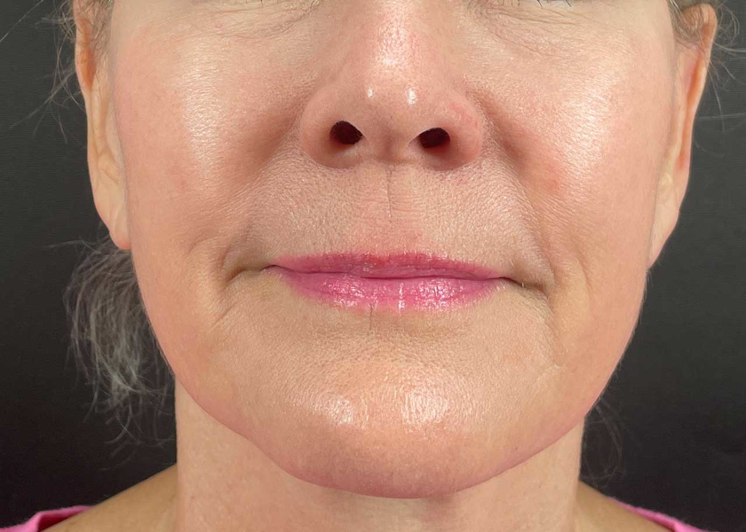 EsmeMedspa_Morpheus8-after