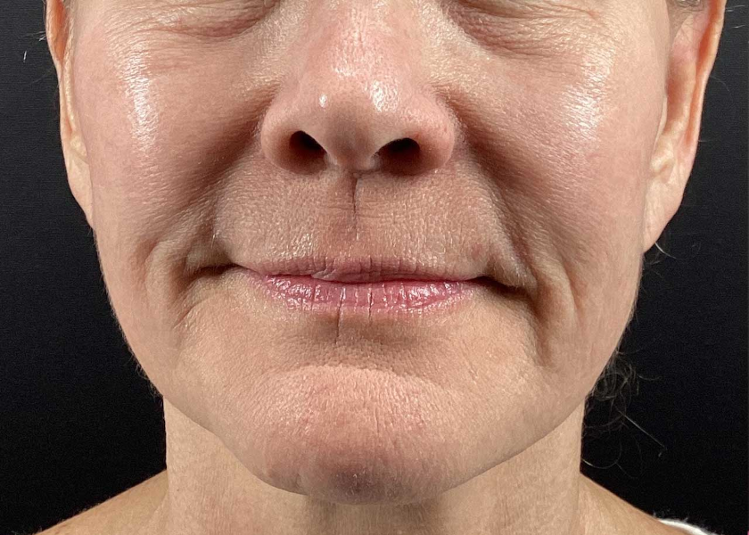 EsmeMedspa_Morpheus8-before