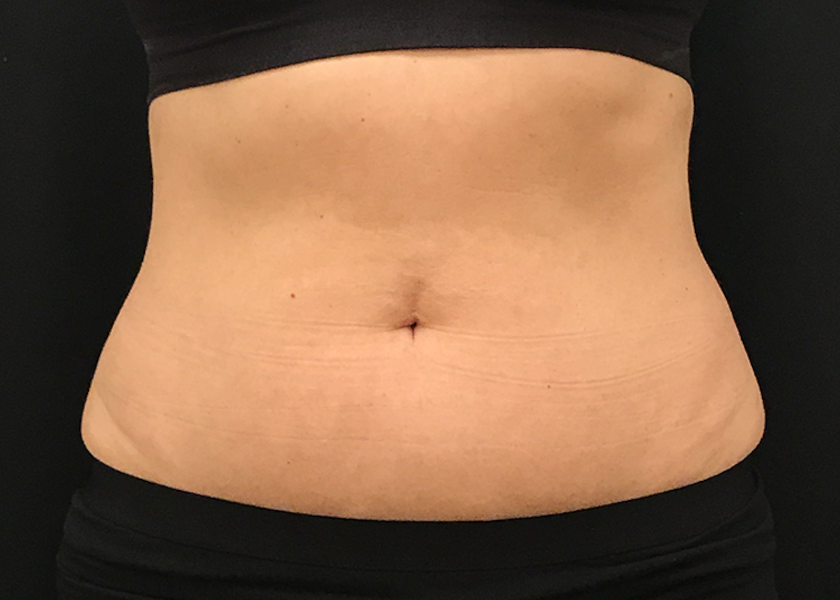 MC_Evolve_1d_Abdomen-after