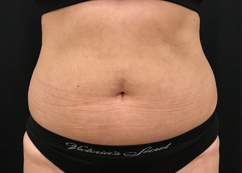 MC_Evolve_1d_Abdomen-before