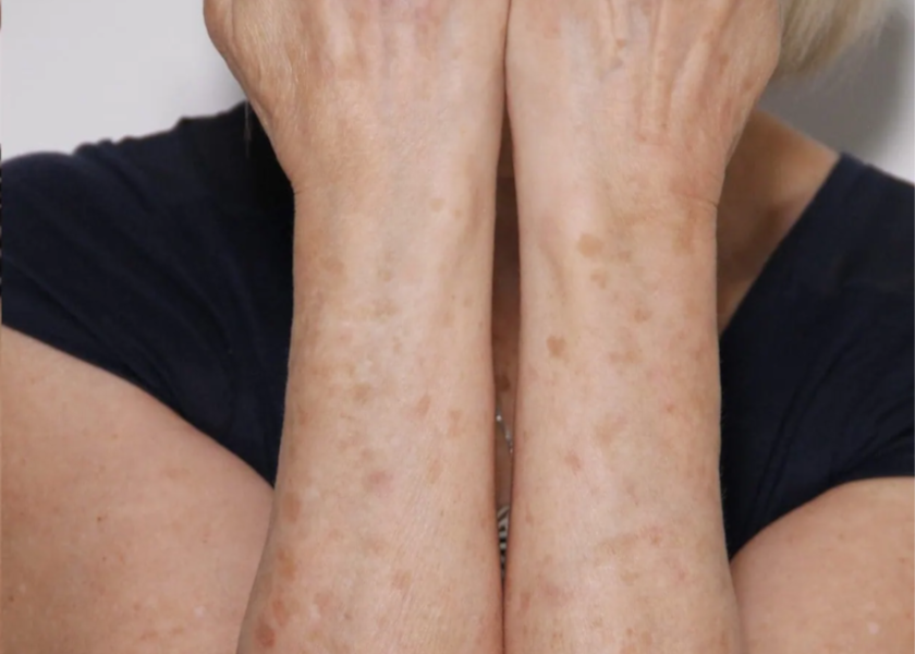 RS_3a_Lumecca_Arms-after