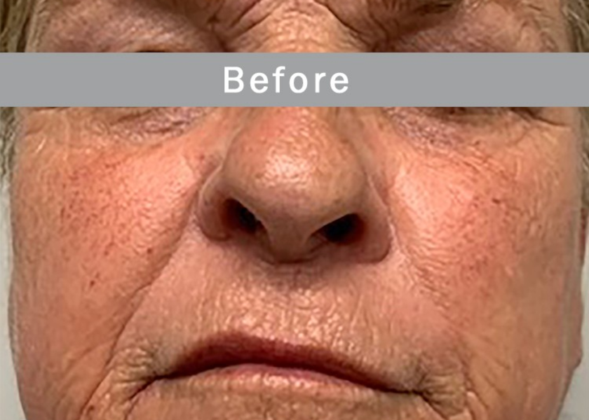 SH_M8_1_FacePerioNeck-before